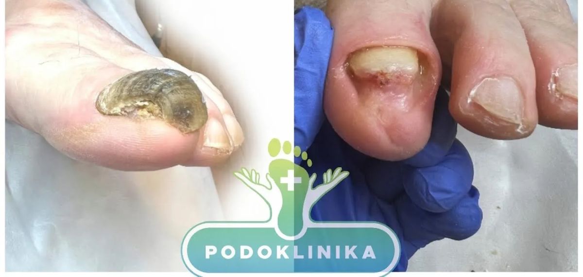 Onichogrifozė Paukščio nagas spac