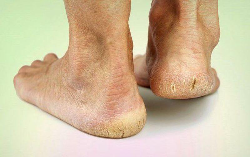 Diabetinė pėda Gydymas diabetinės pėdos simptomai