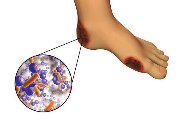 Diabetinė pėda Gydymas - diabetinės pėdos simptomai