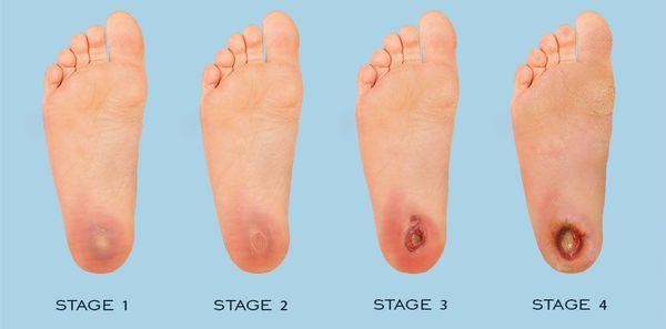 Diabetinės pėdos klasifikacija ir vystymosi etapai