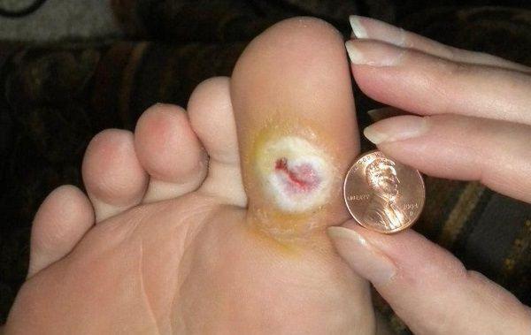 trofinės opos ant kojų, kurios ilgą laiką neišgyja