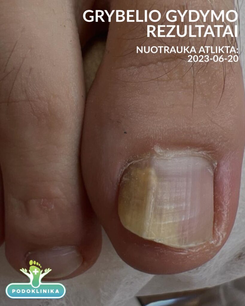 kojų nagų grybelio gydymas prieš procedūrą