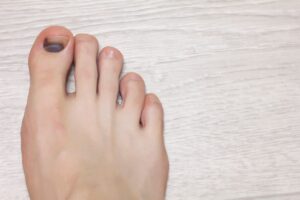 Nukrito ar atšoko kojos nagas – ką daryti?